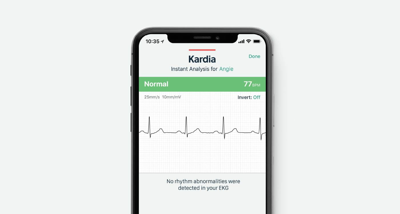 a mobile device showing a normal reading in the Kardia App